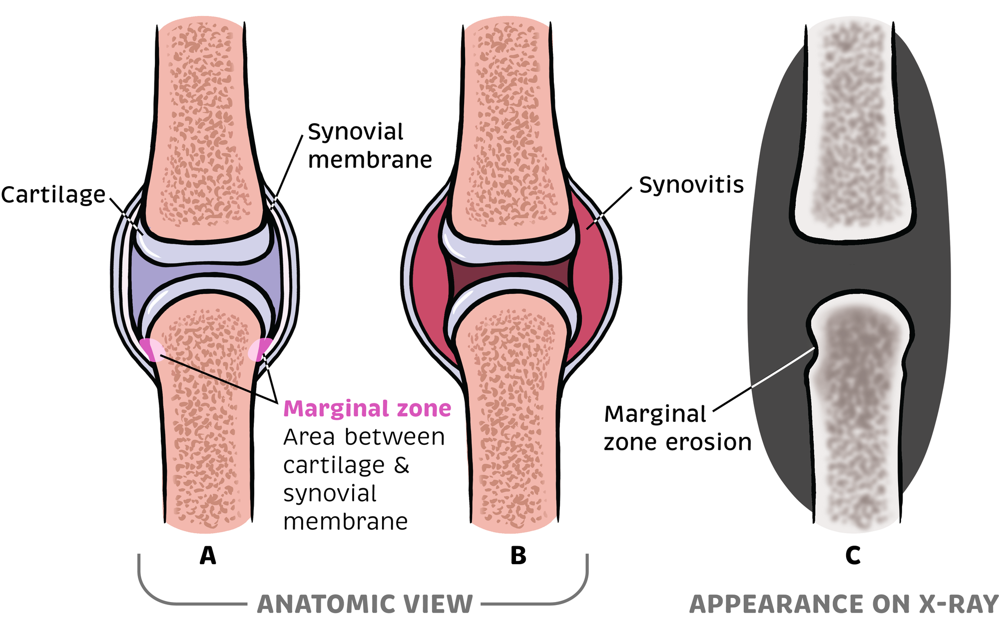 Rheumatology Made Ridiculously Simple